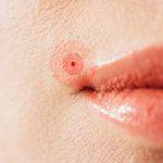 cropped view of herpes on lips of sick woman